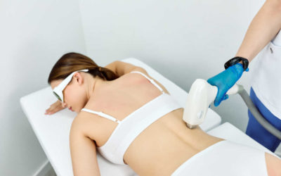 5 benefícios da depilação a laser
