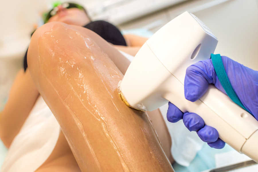 beneficios depilacion laser diodo