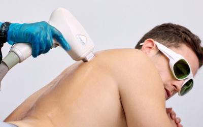Tratamento para a hipertricose: depilação a laser díodo