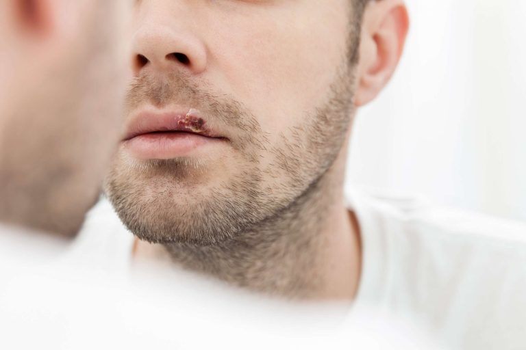 pode fazer depilação a laser com herpes