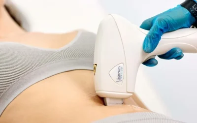 Depilação a laser e colagénio: Quais são os benefícios para a tua pele?
