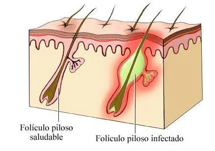 foliculite-pelos-encravados