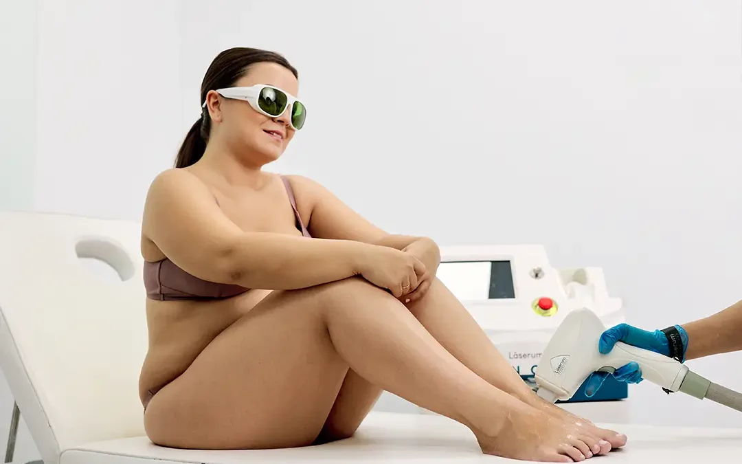 Fiz a depilação a laser e os pelos voltam