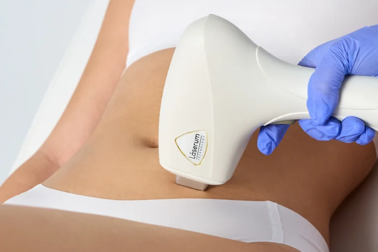 Queimaduras Depilacao a laser
